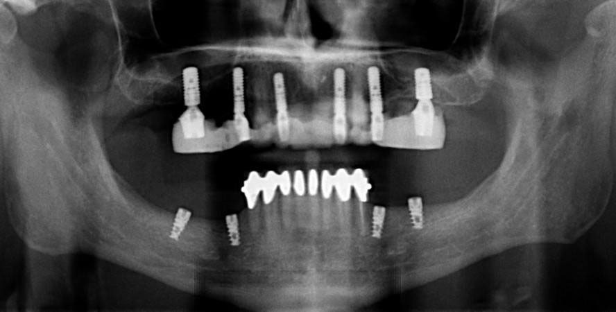 Dental X-rays showing All-on-4 and All-on-6 implant configurations