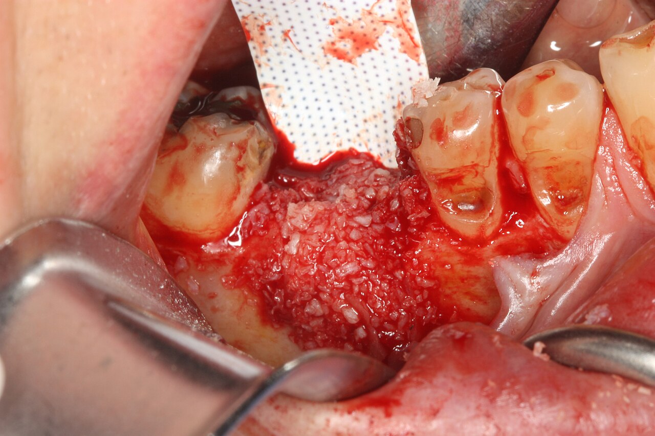Extraction socket with bone graft material and barrier membrane