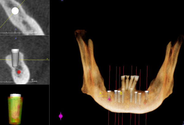 Cone-beam CT scan used for dental implant planning