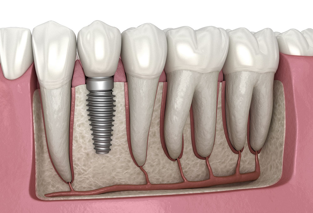 Anatomical illustration of a dental implant showing the titanium fixture, abutment and crown fused with the jawbone